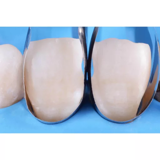 Unica anterior Matrices refill, 12 db.